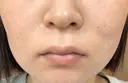 糸リフト / バッカルファット除去 / ボトックス（エラ・小顔） / ヒアルロン酸注入（頬） / フラクショナルレーザー（毛穴・ニキビ跡） TCB東京中央美容外科 仙台駅前院 DAY 28 サムネイル用