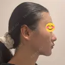脂肪吸引（顔） / ヒアルロン酸注入（あご） HAAB×DREAM BEAUTY CLINIC 東京本院 AFTER サムネイル用