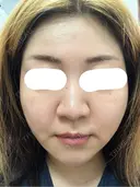 ボトックス（あご） / ボトックス（口角） / ボトックス（額） 東京美容医療クリニック 池袋院 AFTER サムネイル用