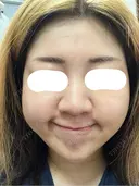 ボトックス（あご） / ボトックス（口角） / ボトックス（額） 東京美容医療クリニック 池袋院 DAY 0 サムネイル用