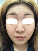 ボトックス（あご） / ボトックス（口角） / ボトックス（額） 東京美容医療クリニック 池袋院 DAY 0 サムネイル用