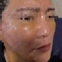 糸リフト / 脂肪吸引（顔） / ボトックス（あご） / ヒアルロン酸注入（あご） / ボトックス（エラ・小顔） / ヒアルロン酸注入（鼻翼基部） Tokyo Tensei Clinic 新宿院 DAY 4 サムネイル用