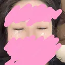 ヒアルロン酸注入（涙袋） AZ BEAUTY CLINIC DAY 0 サムネイル用