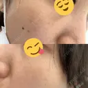 毛穴洗浄（ハイドラフェイシャルなど） / ピコレーザートーニング（美白・肝斑） CIEL SKIN CLINIC（シエルスキンクリニック） DAY 18 サムネイル用