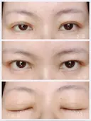 二重埋没 共立美容外科 新宿本院 AFTER サムネイル用