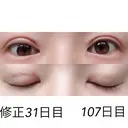 二重埋没 / 目元修正 湘南美容クリニック 広島院 DAY 31 サムネイル用