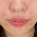 ヒアルロン酸注入（唇） / ヒアルロン酸注入（鼻翼基部） HAAB×DREAM BEAUTY CLINIC 大阪梅田院 AFTER サムネイル用