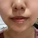 脂肪吸引（顔） ネビュラクリニック 京都院 AFTER サムネイル用