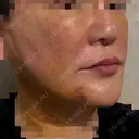 糸リフト / 脂肪吸引（顔） / ボトックス（あご） / ヒアルロン酸注入（あご） / ボトックス（エラ・小顔） / ヒアルロン酸注入（鼻翼基部） Tokyo Tensei Clinic 新宿院 DAY 5 サムネイル用