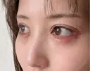 脂肪注入（目の下） アネシス美容クリニック DAY 14 サムネイル用