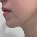 ハイフ（顔） S-Laboクリニック 渋谷院 AFTER サムネイル用