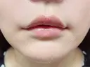 ヒアルロン酸注入（唇） 目白ホワイトクリニック DAY 0 サムネイル用