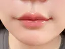 ヒアルロン酸注入（唇） 目白ホワイトクリニック DAY 1 サムネイル用