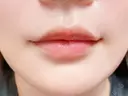 ヒアルロン酸注入（唇） 目白ホワイトクリニック DAY 2 サムネイル用