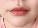 ヒアルロン酸注入（唇） 目白ホワイトクリニック DAY 5 サムネイル用