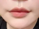 ヒアルロン酸注入（唇） 目白ホワイトクリニック AFTER サムネイル用