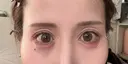 脂肪注入（目の下） アネシス美容クリニック AFTER サムネイル用