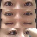 眼瞼下垂（切開） / 上まぶたの脂肪取り 白山クリニック 大分 DAY 27 サムネイル用