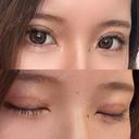 二重切開 MIL CLINIC OSAKA AFTER サムネイル用