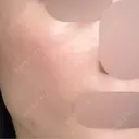 レーザートーニング（美白・かんぱん） トラスト美容クリニック 銀座院 AFTER サムネイル用