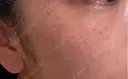 ルメッカ ルラ美容クリニック 上野院 DAY 2 サムネイル用