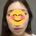 糸リフト / 脂肪吸引（顔） / ボトックス（エラ・小顔） RIVER CLINIC（リバークリニック） AFTER サムネイル用