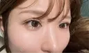 二重埋没 / 目頭切開 アリエル美容クリニック 大宮院 DAY 14 サムネイル用