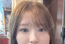二重埋没 / 目頭切開 アリエル美容クリニック 大宮院 DAY 14 サムネイル用