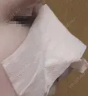 隆鼻術 / 鼻尖形成（切開） / 鼻中隔延長（切開） / その他（輪郭） リッツ美容外科 東京院 DAY 1 サムネイル用