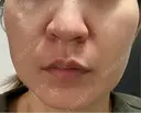 ピコレーザートーニング（美白・肝斑） / フラクショナルレーザー（毛穴・ニキビ跡） ルラ美容クリニック 横浜院 DAY 1 サムネイル用