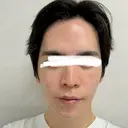 骨切り（あご） / 骨削り（頬） / 輪郭修正 シェリークリニック 渋谷院 DAY 90 サムネイル用