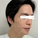 骨切り（あご） / 骨削り（頬） / 輪郭修正 シェリークリニック 渋谷院 DAY 90 サムネイル用