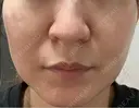 ピコレーザートーニング（美白・肝斑） / フラクショナルレーザー（毛穴・ニキビ跡） ルラ美容クリニック 横浜院 DAY 2 サムネイル用