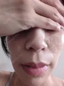 リジュラン ワンストップヘアクリニック 大阪院 DAY 0 サムネイル用