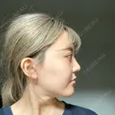 クマ治療 / リジュラン エートップ美容整形外科 DAY 40 サムネイル用