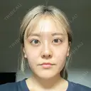 クマ治療 / リジュラン エートップ美容整形外科 DAY 40 サムネイル用