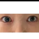 目頭切開 ネビュラクリニック 京都院 DAY 17 サムネイル用