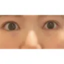 目頭切開 ネビュラクリニック 京都院 DAY 20 サムネイル用