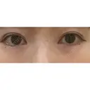 目頭切開 ネビュラクリニック 京都院 DAY 137 サムネイル用