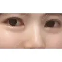 目頭切開 ネビュラクリニック 京都院 DAY 32 サムネイル用