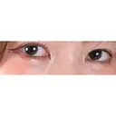 目頭切開 ネビュラクリニック 京都院 AFTER サムネイル用
