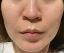 ピコレーザートーニング（美白・肝斑） / フラクショナルレーザー（毛穴・ニキビ跡） ルラ美容クリニック 横浜院 DAY 4 サムネイル用