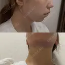 糸リフト / 脂肪吸引（顔） / ジョールファット除去 RIVER CLINIC（リバークリニック） DAY 0 サムネイル用