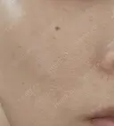 ルメッカ ルラ美容クリニック 名古屋栄院 / ルラスキンクリニック 名古屋栄院 AFTER サムネイル用