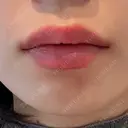 ヒアルロン酸注入（唇） 目白ホワイトクリニック DAY 0 サムネイル用