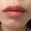 ヒアルロン酸注入（唇） 目白ホワイトクリニック DAY 1 サムネイル用