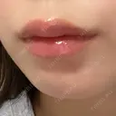 ヒアルロン酸注入（唇） 目白ホワイトクリニック DAY 1 サムネイル用