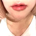 ヒアルロン酸注入（唇） 目白ホワイトクリニック AFTER サムネイル用