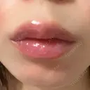 ヒアルロン酸注入（唇） 目白ホワイトクリニック DAY 2 サムネイル用