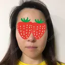 ボトックス（エラ・小顔） 湘南美容クリニック 京都院 DAY 14 サムネイル用